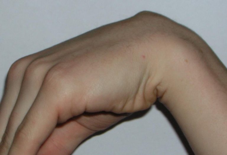 Photograph of a wrist bent forwards with the ganglion on the back of the wrist ringed in red