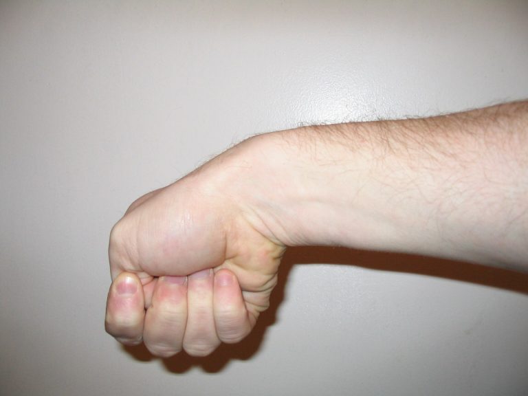 Clinical test for de Quervain tenosynovitis with the painful area on the thumb side of the wrist ringed in red
