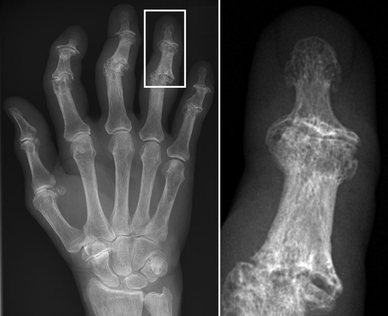X-ray of the fingers with the worn fingertip joints ringed in red