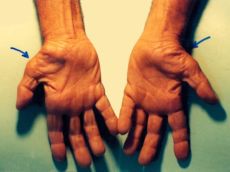 Palms of both hands with the thenar muscle pad at the base of each thumb ringed in red