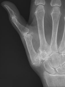 X-ray of the hand with the worn joint at the base of the thumb ringed in red